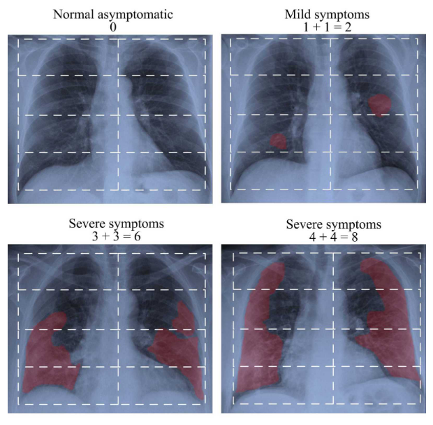 Severidad de síntomas en radiografías